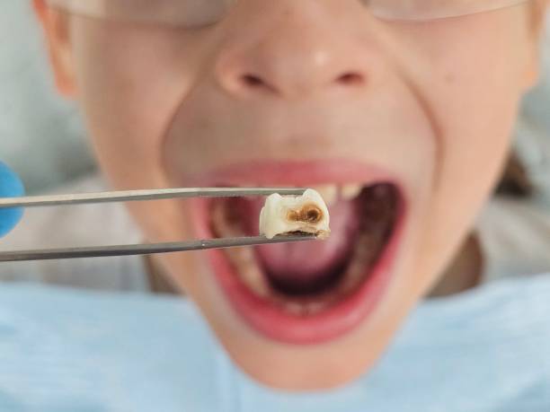 Best Emergency Wisdom Tooth Extraction in Parkville, MO